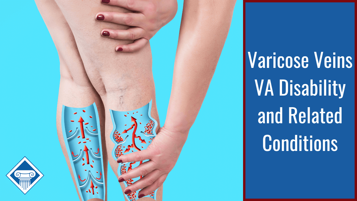 Do Veterans to Get VA Disability for Chronic Venous Insufficiency (CVI)?