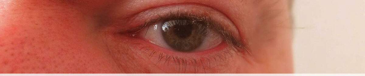 Picture of a man's eye close-up. Our title is below: How scleritis and swollen eyes increase your VA disablity rating.